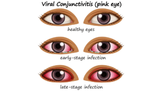 Conjectivitis_Symptoms_Causes_Preventions